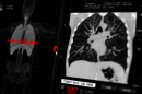 Screening for lung cancer